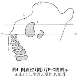 新生兒肛門和直腸畸形