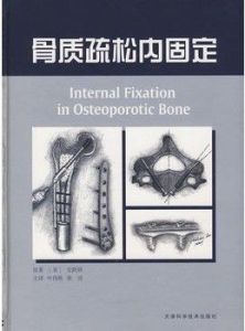 骨質疏鬆內固定 骨質疏鬆內固定