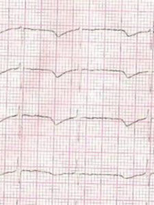 心率過快 心率過快