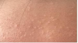 閉合性痘痘 閉合性痘痘