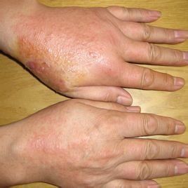 乾性脂溢性皮炎 乾性脂溢性皮炎