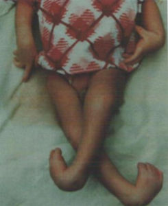 多巴反應性肌張力障礙 多巴反應性肌張力障礙