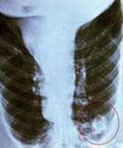 肺炎衣原體 肺炎衣原體