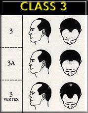 三級脫髮 三級脫髮