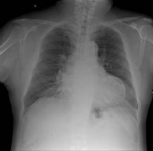 老年鈣化性瓣膜病