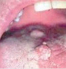 口腔尖銳濕疣 口腔尖銳濕疣