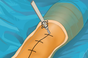 虛擬膝關節手術 虛擬膝關節手術