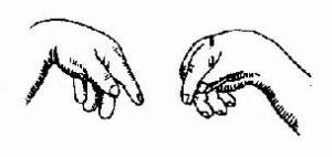 維生素D缺乏型手足搐搦症 維生素D缺乏型手足搐搦症