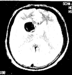 顱內占位性病變