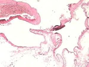 小腸血管畸形 小腸血管畸形