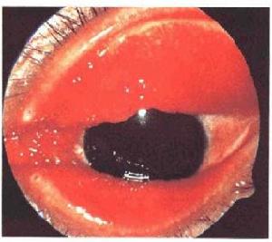 流行性角結膜炎