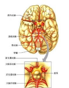 腦動脈阻塞 腦動脈阻塞