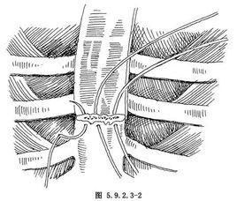 胸骨骨折內固定術 胸骨骨折內固定術