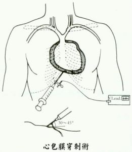 心包穿刺 心包穿刺