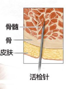 骨髓穿刺術 骨髓穿刺術