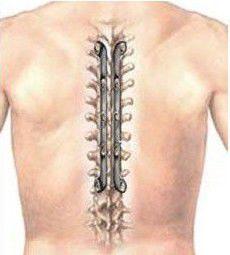 強直性脊柱炎早期 強直性脊柱炎早期