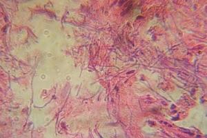 厭氧菌感染的肝臟微觀圖