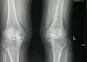 膝關節骨性關節炎
