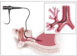支氣管熱成型術 支氣管熱成型術