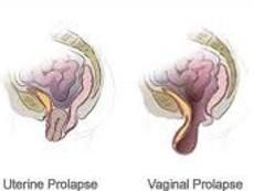 肛門下墜 肛門下墜