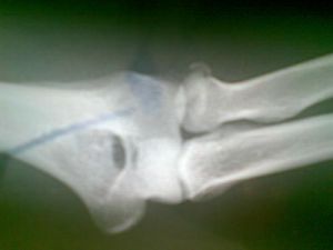 肘尖向上突出 肘尖向上突出