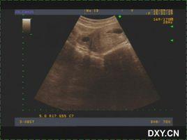 妊娠黃體 妊娠黃體