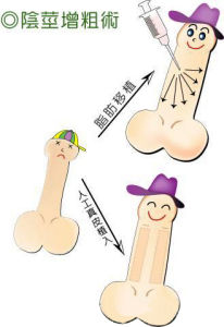 陰莖增粗術 陰莖增粗術