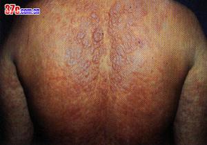 淋巴結型黑熱病 淋巴結型黑熱病