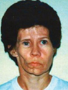 Parry-Romberg綜合徵 Parry-Romberg綜合徵