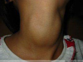 甲狀腺疾病 甲狀腺疾病