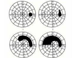 生理盲點擴大 生理盲點擴大