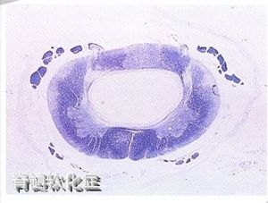 脊髓軟化 脊髓軟化