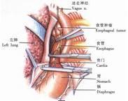 示意圖3:將胃進行游離，自賁門部位切斷