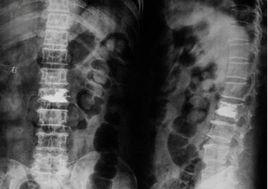 胸，腰椎爆裂骨折