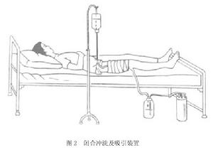 （圖）慢性血源性骨髓炎