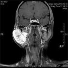 面神經血管瘤 面神經血管瘤