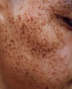 日光性雀斑樣痣 日光性雀斑樣痣