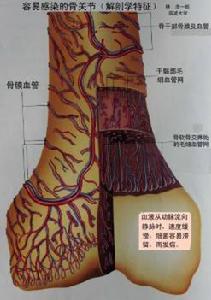 （圖）慢性血源性骨髓炎