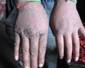 凍結性冷傷 凍結性冷傷