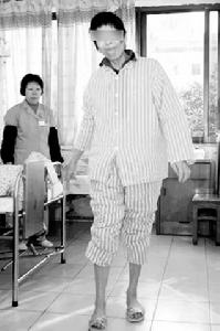 亨廷頓病性痴呆