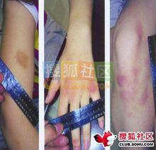 某次被打後的傷情鑑定