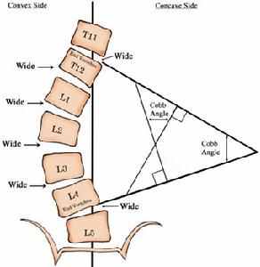先天性脊柱側凸
