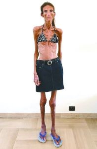 如今體重27公斤的瓦萊麗婭