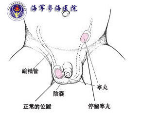 小兒隱睪 小兒隱睪
