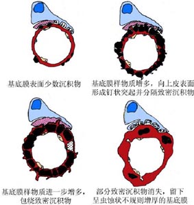 過敏性紫癜綜合徵