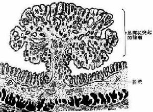 腸息肉病 腸息肉病