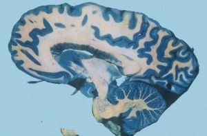 蘿莉控的大腦組織