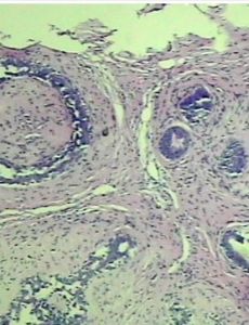 乳腺包塊 乳腺包塊