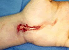 抗藥性細菌“KPC” 抗藥性細菌“KPC”