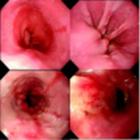 非糜爛性反流病 非糜爛性反流病